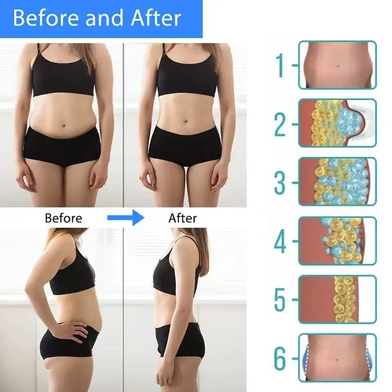 Lipocongelamento Abdominal Removedor De Gordura